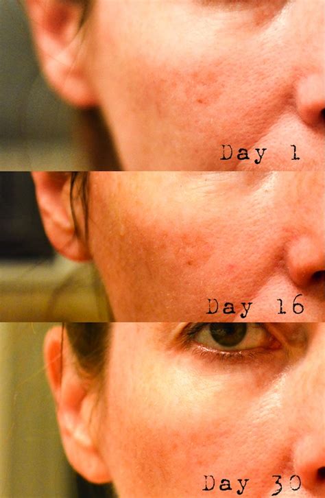 tria age defying laser  day follow   vals kitchen