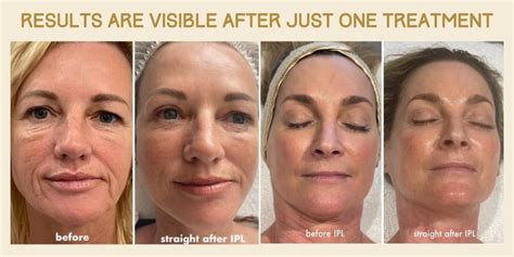 IPL Skin Rejuvenation - Beauty Sanctuary