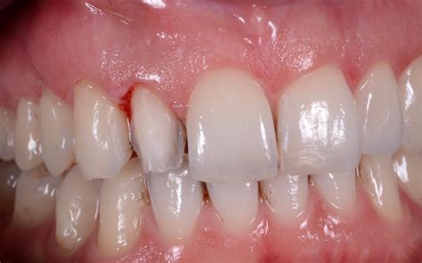 faccetta laterale milling pro