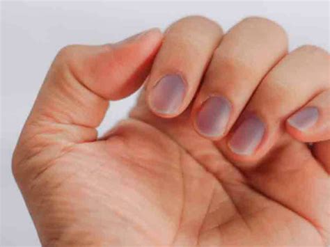 Uñas moradas: por qué se ponen de ese color sin haber sufrido un golpe ...