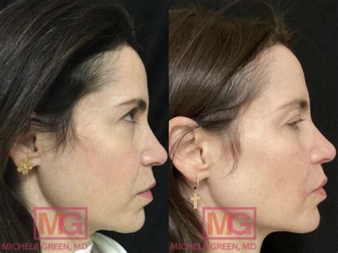 thermage    skin tightening patient photo