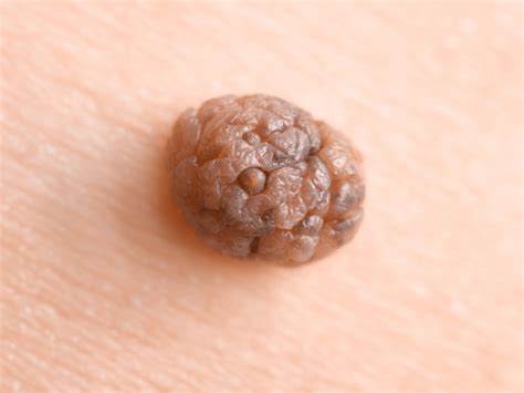 ホクロと皮膚がんの見分け方：専門医が教える3つの重要ポイント | 健康情報メディア