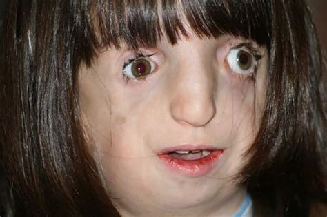 severe treacher collins syndrome