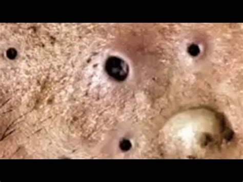Blackhead Blackhead Blackheads - YouTube