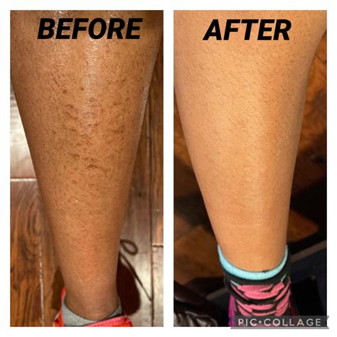 32 best r/ichthyosis images on Pholder | Someone on Reddit told me I
