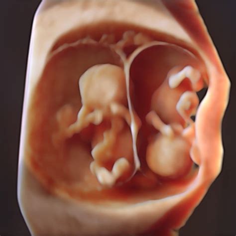 multiple pregnancy scans trinity imaging