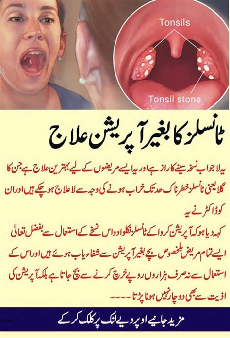 What are Tonsils: Get Rid of Tonsils by Natural Home Remedies | Daily