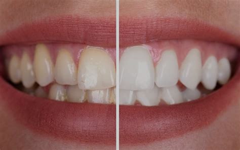 The Benefits and Risks of Teeth Whitening – Pure Bliss Dental Care