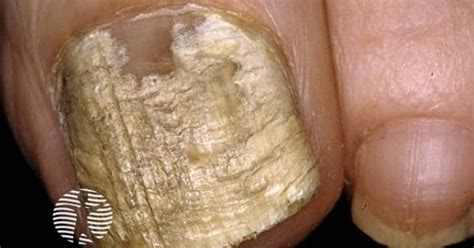 candida albicans affecting  nail image