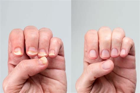 Micosi unghie: rimedi naturali efficaci – Secondamano®