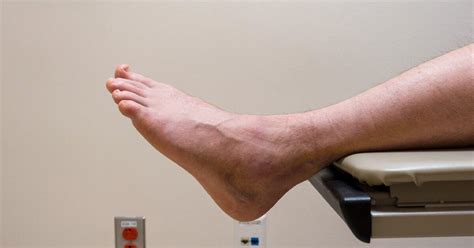 fracture    metatarsal types symptoms  treatment
