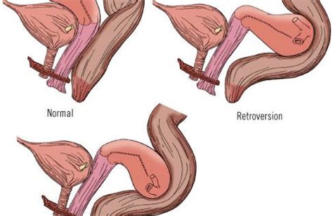 Retroverted Uterus Pregnancy