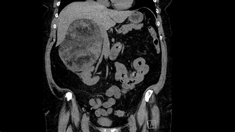 Adrenal myelolipoma CT scan | Surgery Photos