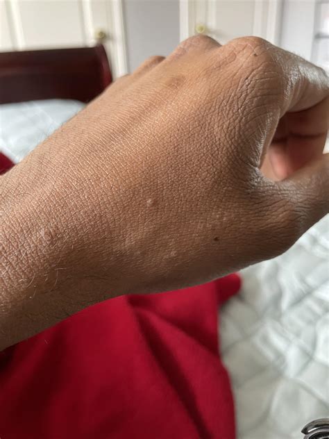 Small Skin Bumps On Hands - Tracking