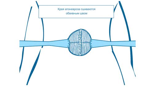 Пупочная грыжа