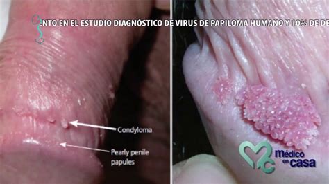 Infección de (VPH) Virus de Papiloma Humano en el hombre - YouTube