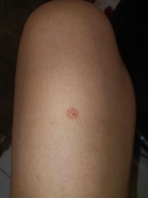 Possible bat bite? : r/DiagnoseMe