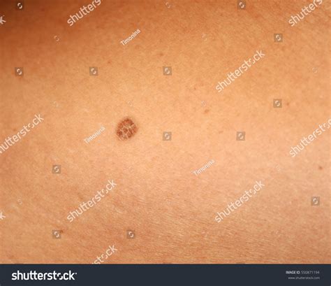 Brown Spots On Skin Spot Dark Stock Photo 550871194 | Shutterstock