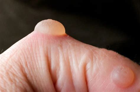 Blisterata: A Revolutionary Approach to Blister Relief