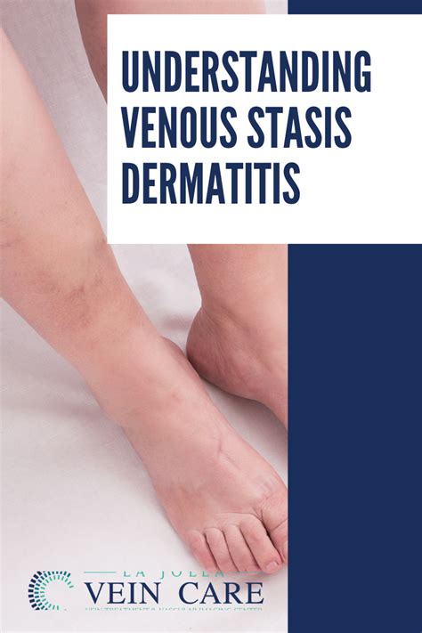 Understanding Venous Stasis Dermatitis