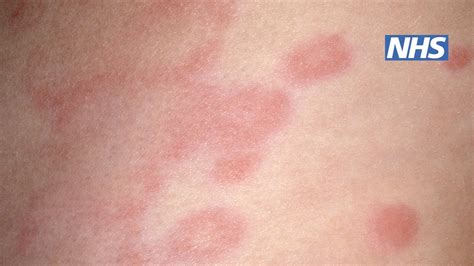 face rash hives  vernon virgil blog