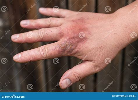 refrigerant burn  hand  irish lin blog