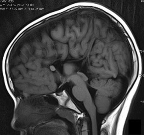 Agenesis of corpus callosum – Radiology Cases