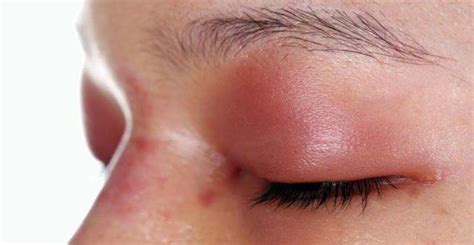 phlegmon syyt oireet hoito