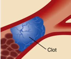 types  stroke ischemic flashcards quizlet