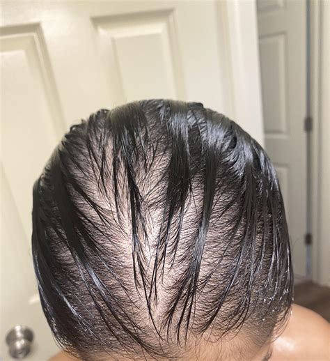 I didn’t realize how bad my hair loss had gotten until I took this