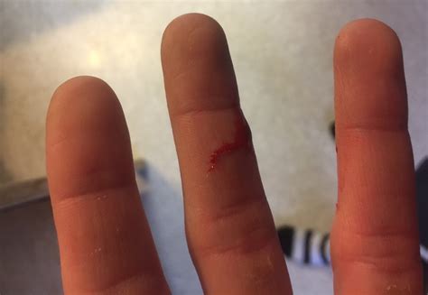 cut on finger throbbing 2