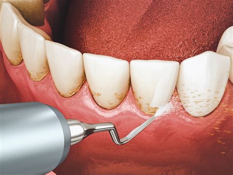scaling  root planing uptown family dental