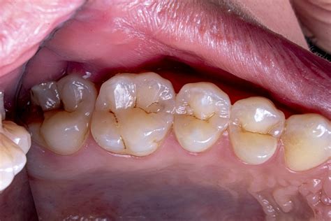 dental plaque pictures   images  unsplash