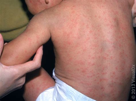 Rubella vs. Rubeola (Measles): Differences, Photos, and More - GoodRx