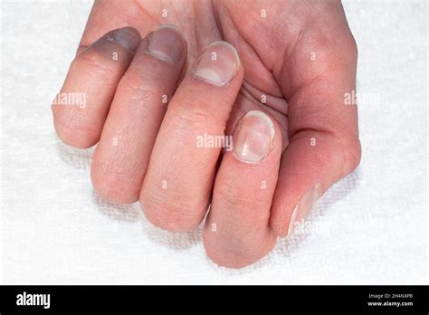 Overgrown gel nails hi-res stock photography and images - Alamy