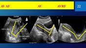 Uterus | Radiology Reference Article | Radiopaedia.org