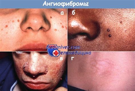 Ангиофиброматозные пролиферации или ангиофибромы. Аденома sebaceum.