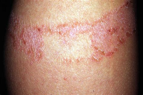 common skin conditions