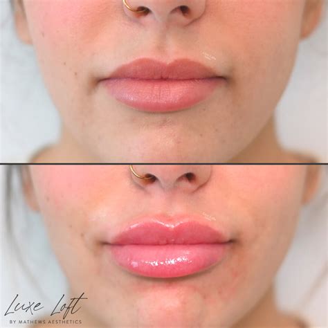 lip filler gallery  stunning transformations luxe loft