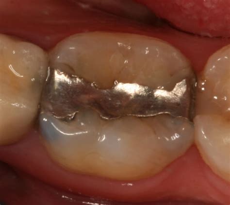 Porcelain Crowns | Inlay Onlay - Adler Cosmetic & Family Dentistry