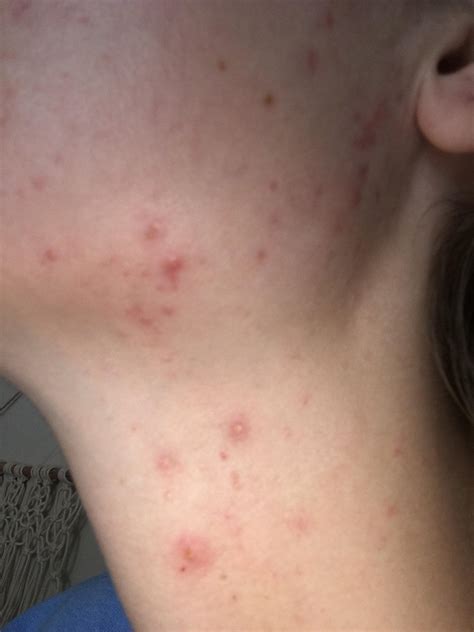Why Is My Neck Acne So Bad at Helen Mckenzie blog