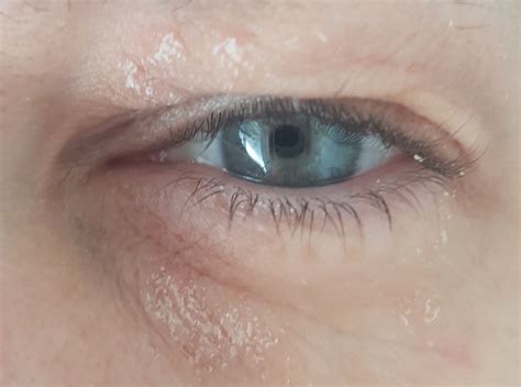 What To Put On Dry Itchy Skin Around Eyes at Melissa Dunphy blog