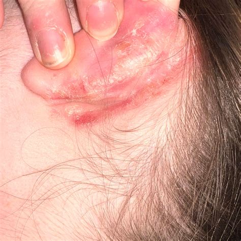 Extremely dry/flaky skin around ears. I’ve tried everything - changing