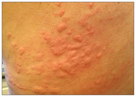 urticaria  chronic hives  advice   advocate