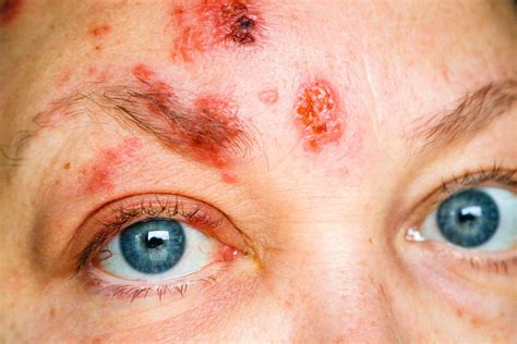 facial herpes zoster shingles  donna willey blog