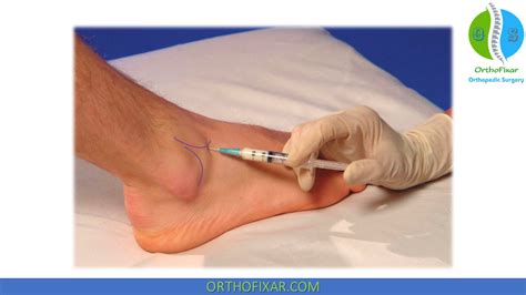 ankle steroid injection easily step  step orthofixar