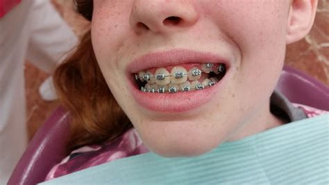 color de brackets para mujeres 5