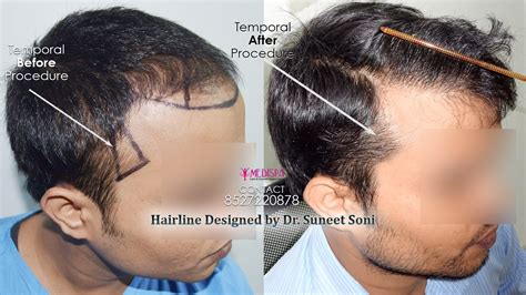 dr joy hair transplant  beth meeks blog