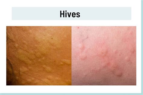 Raised Skin Bumps: 44 Causes, Pictures and Treatment