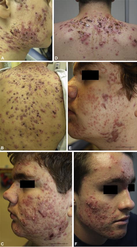 Acne Fulminans Before And After